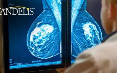 Candelis Lauded by Frost & Sullivan for Accelerating Accurate Diagnosis with Its Multi-Modal Breast Imaging Solution, Advanced Breast Imaging Enterprise Viewer